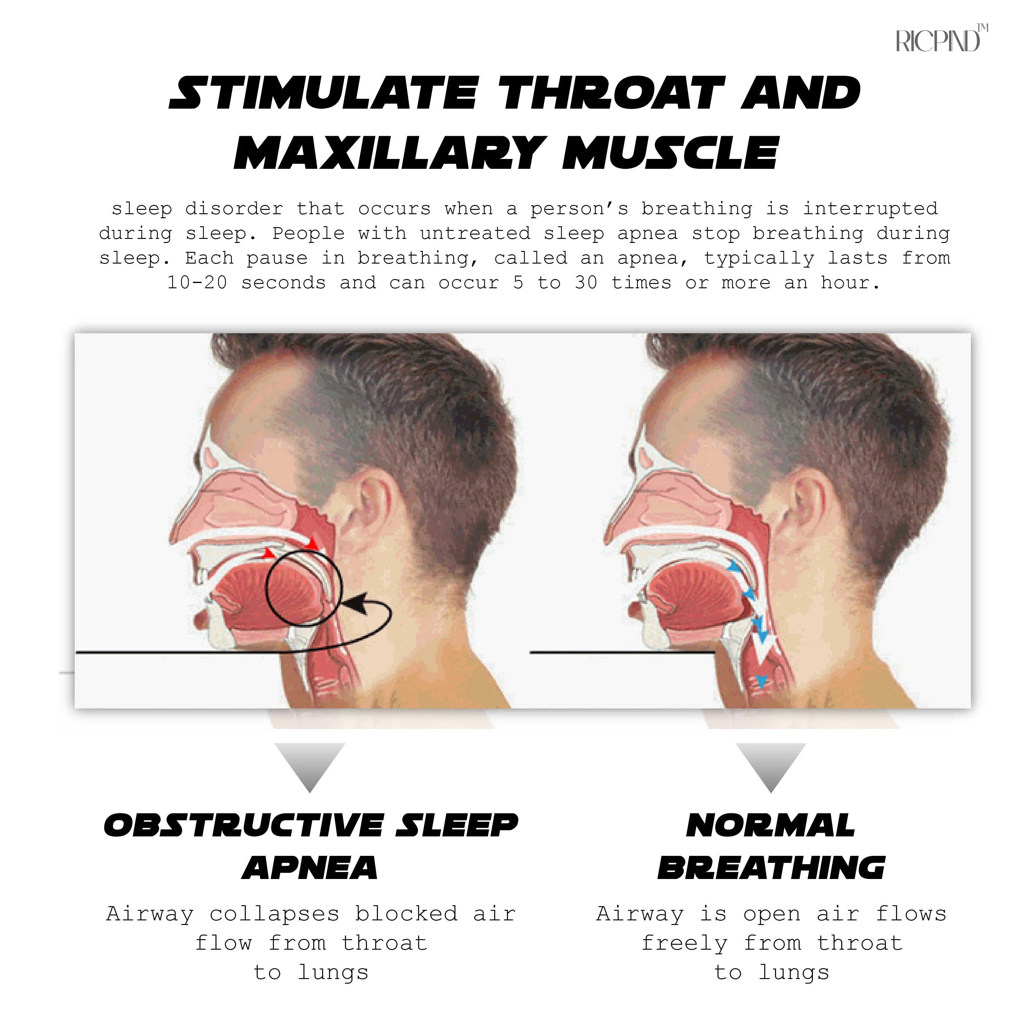 Ricpind AI Instant SnoringReduction Vibrating Stopper