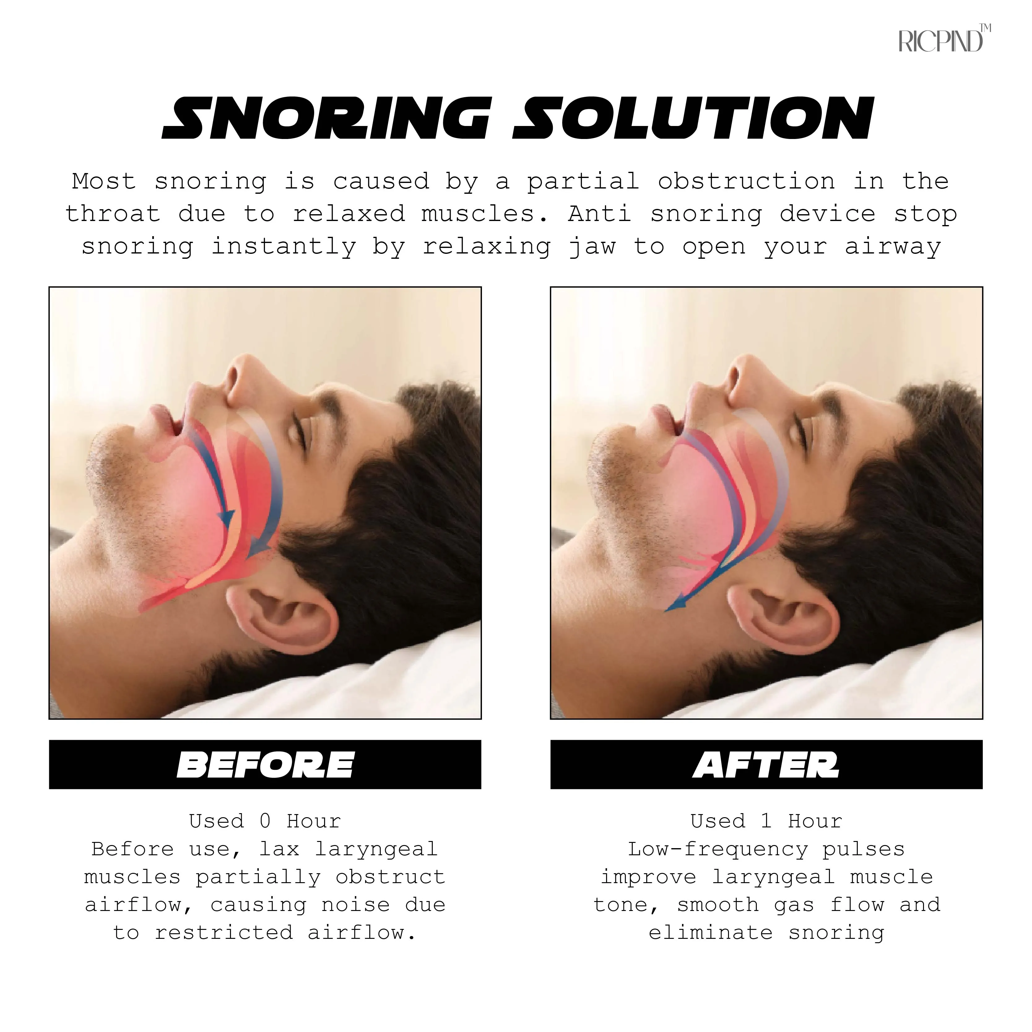 Ricpind AI Instant SnoringReduction Vibrating Stopper